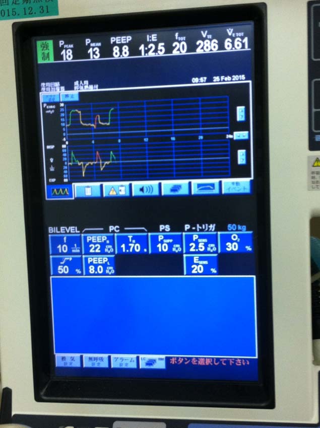 人工呼吸器のモニター画面